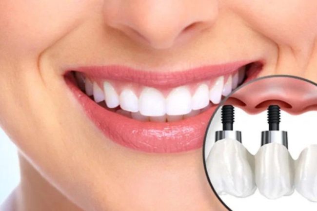 fractured tooth repai