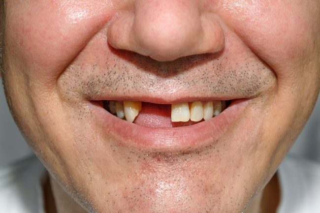 loose tooth