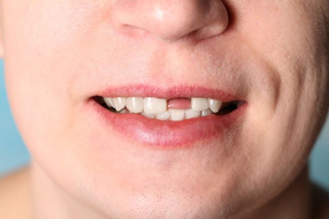 split tooth repair
