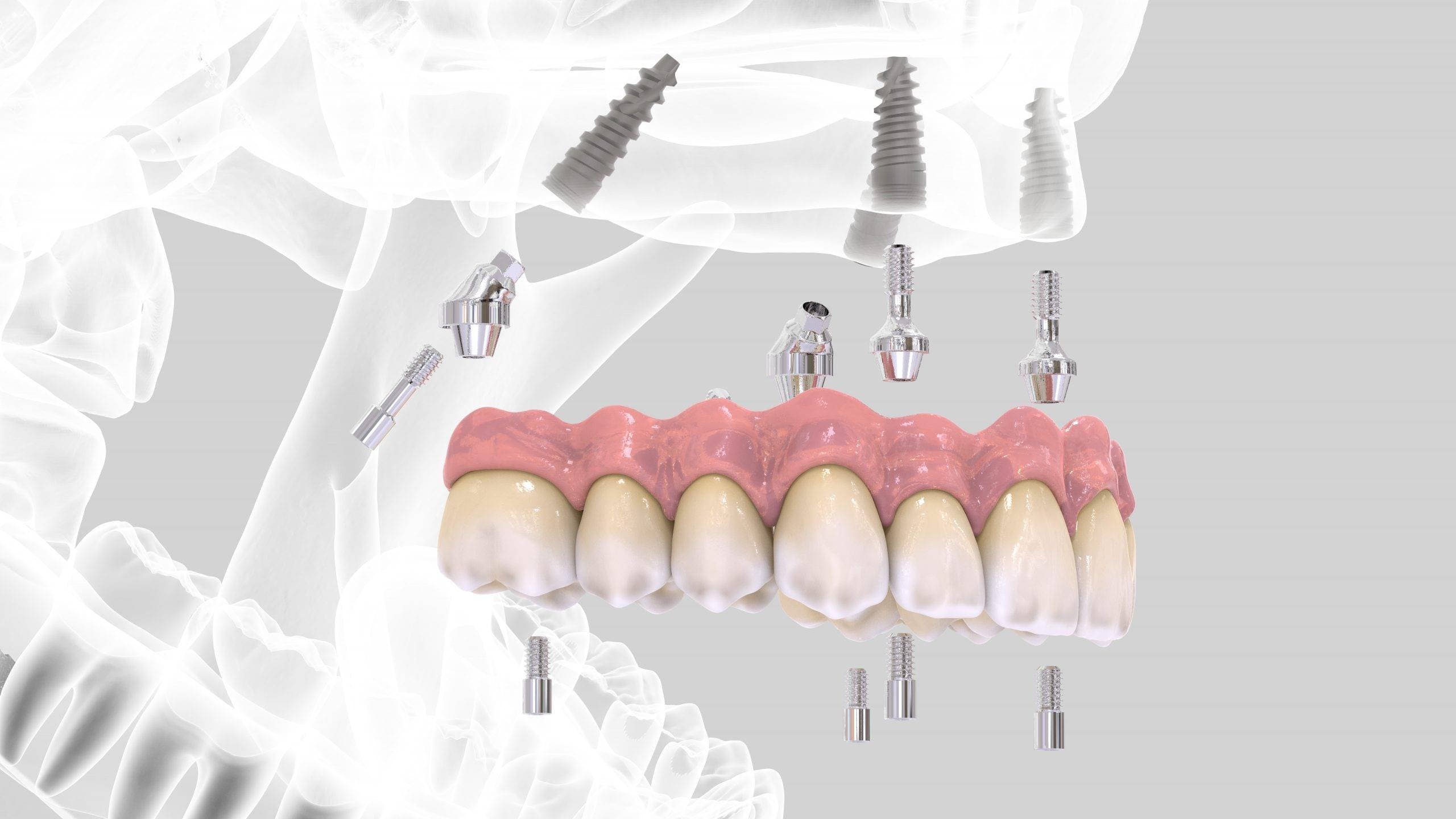 All-on-4 dental implants for full arch restoration