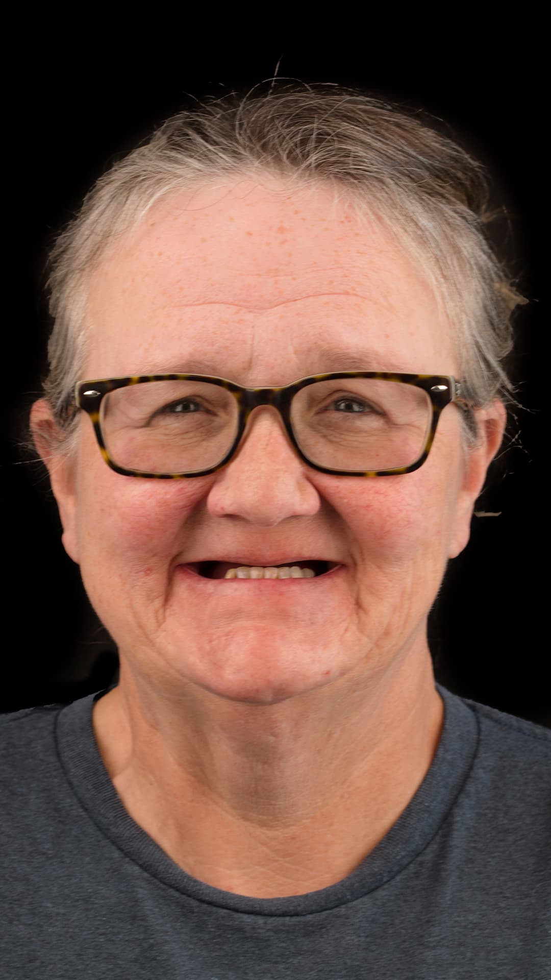 After: Complete Smile Makeover