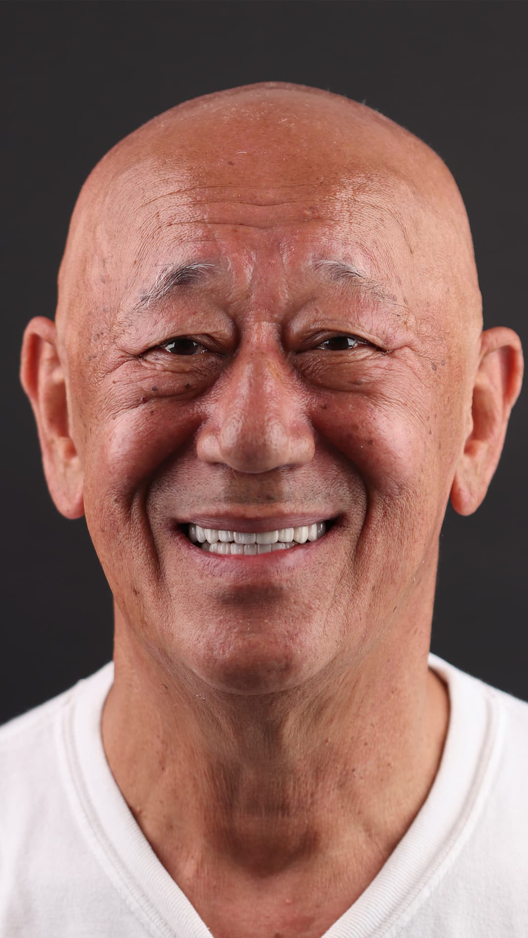 After: Complete Dental Restoration