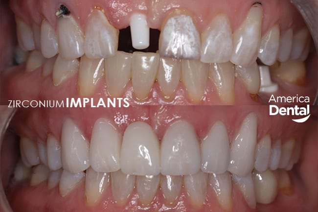 Zirconio Dental Implants Restoration