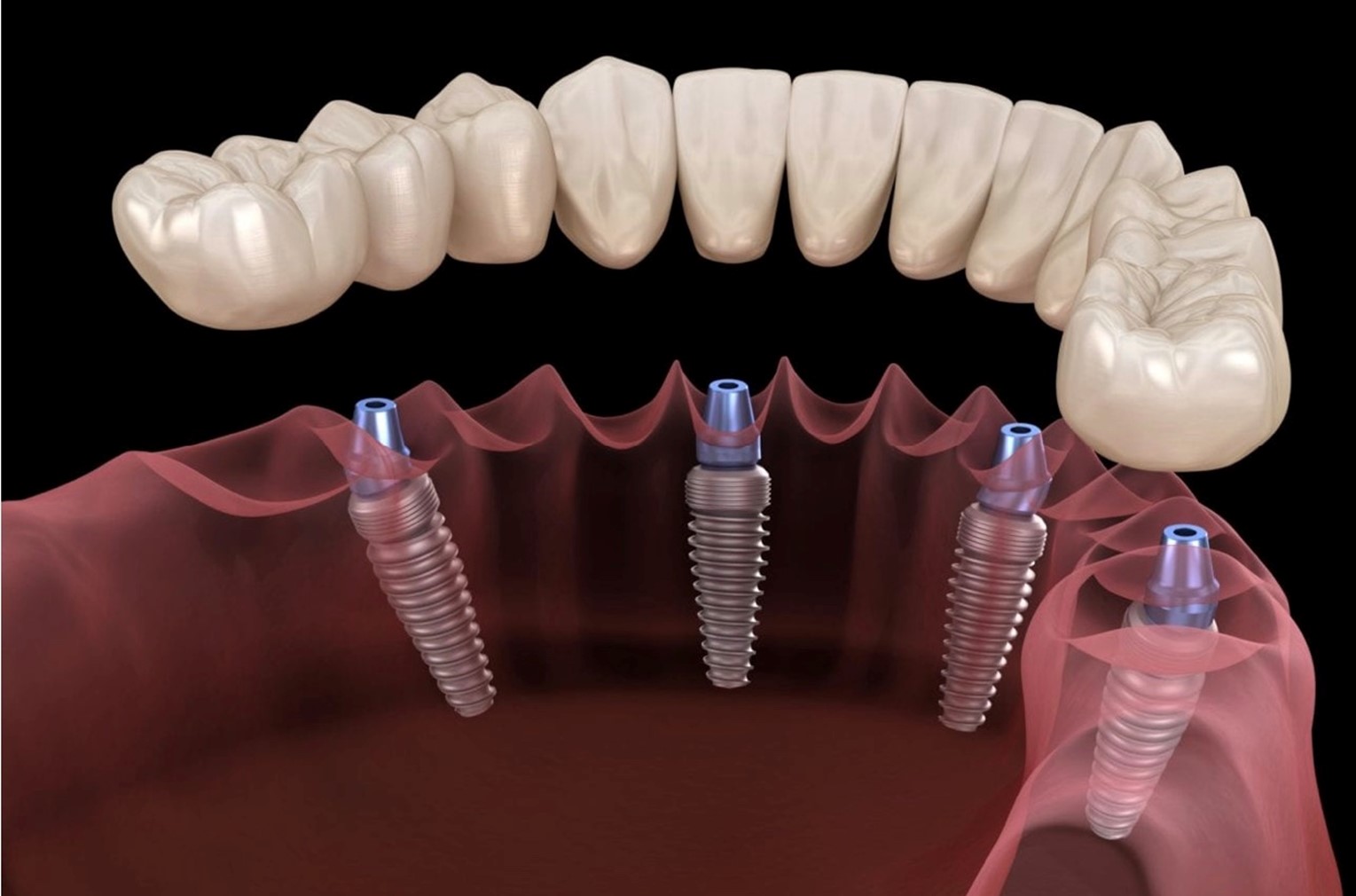 all on 4 dental implants