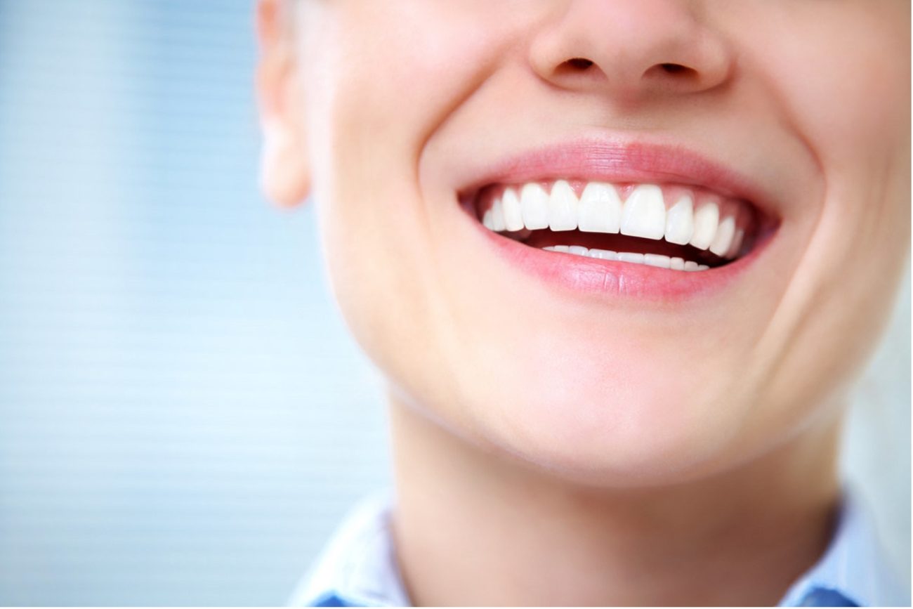 Dental Veneers Self