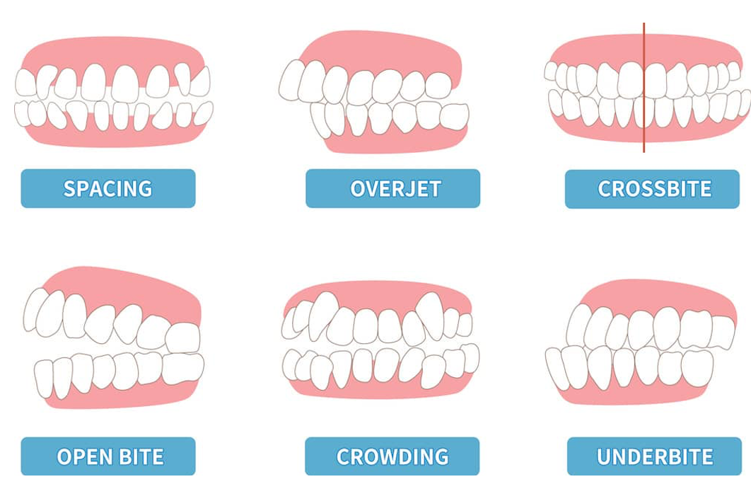 ️ Find the solution Orthodontics for Bite Problems