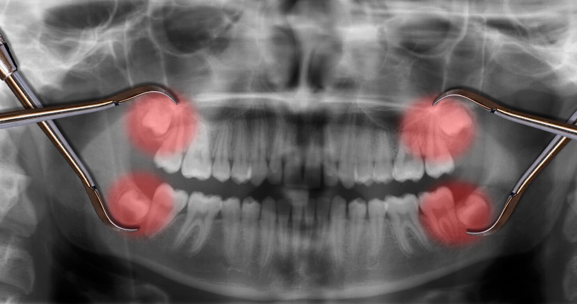 Wisdom Extractions