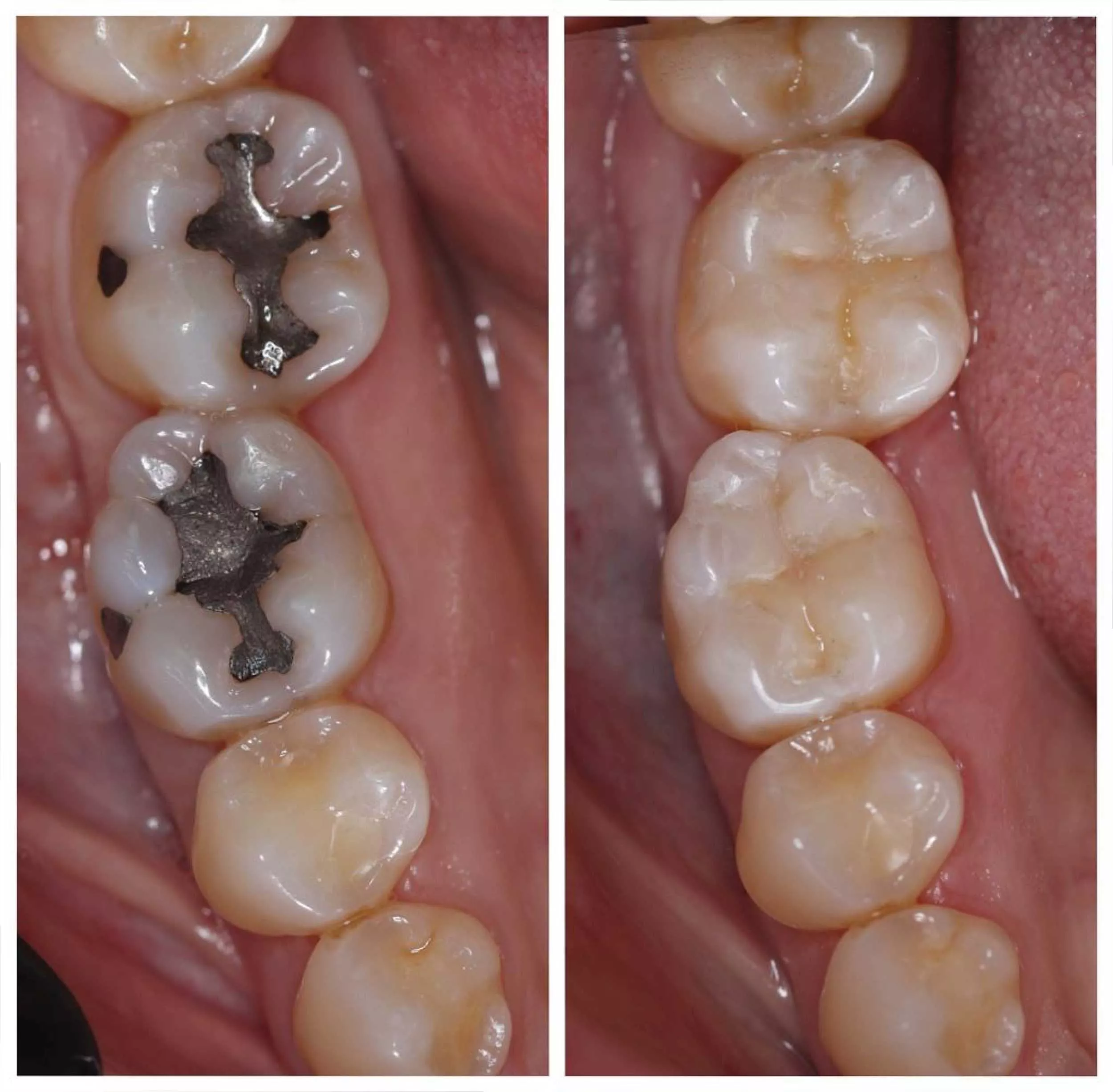 safe mercury amalgam removal