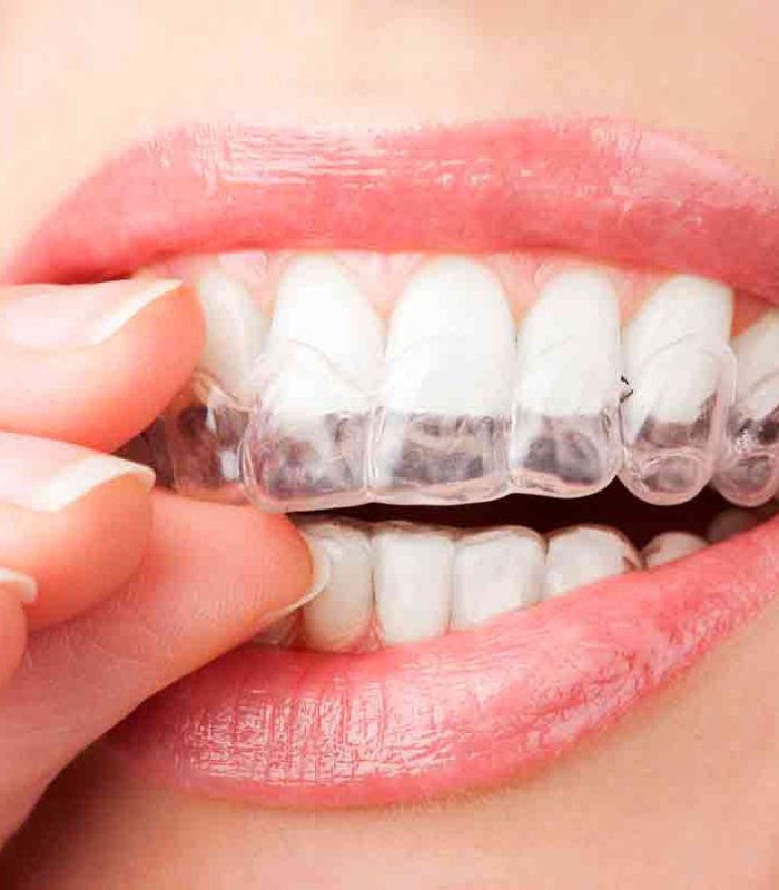 Invisalign