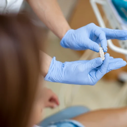 composite veneers