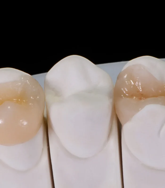 onlay in dentistry.jpeg